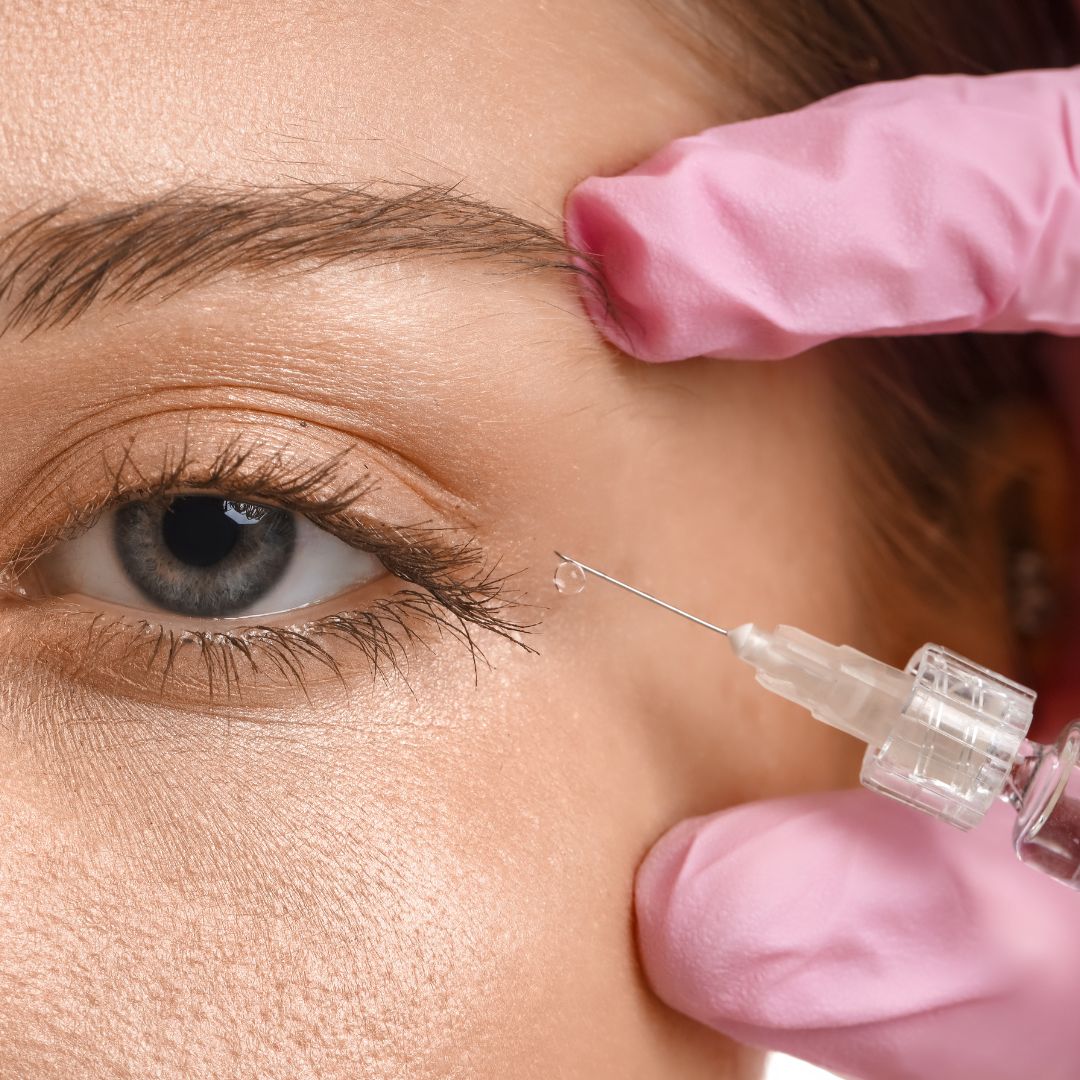 Refreshed under-eye area with significantly reduced shadowing following tear trough filler treatment